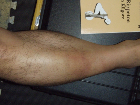 Bruised Shins Bruised Shins