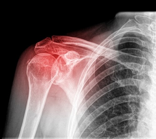 Shoulder Pain Shoulder Pain